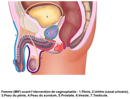 Forme masculine avant l'oération