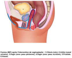 Forme finale après l'oération
